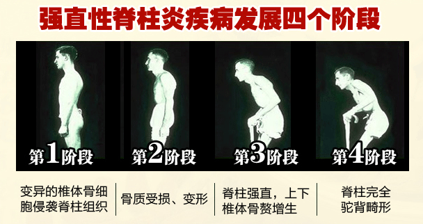 強直性脊柱炎病情發(fā)展配圖.jpg