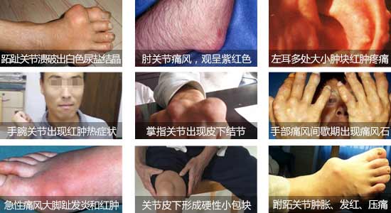 貴陽(yáng)強(qiáng)直醫(yī)院痛風(fēng)發(fā)病的癥狀.jpg